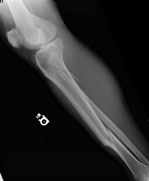 Broken Leg 2nd X-Ray : Biological Science Picture Directory – Pulpbits.net