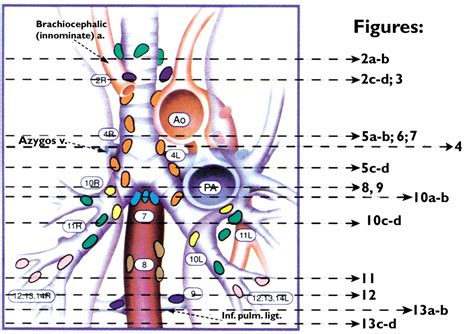 Ct Depiction Of Regional Nodal Stations For Lung Cancer Staging Ajr