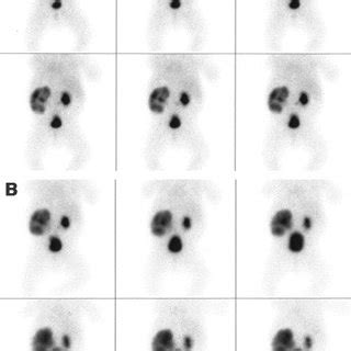 (PDF) Value of supranormal function and renogram patterns on 99mTc- mercaptoacetyltriglycine ...