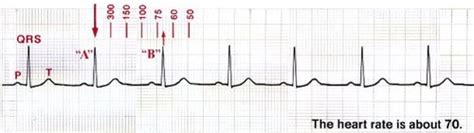 Step Process To Rhythm Interpretation Code One Cpr Training