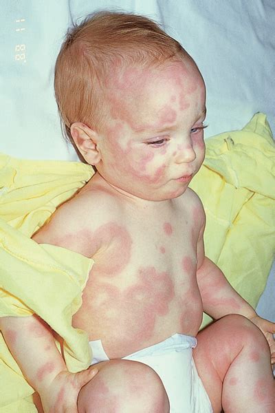 Erythema Multiforme Pediatric Diseases And Conditions 5minuteconsult