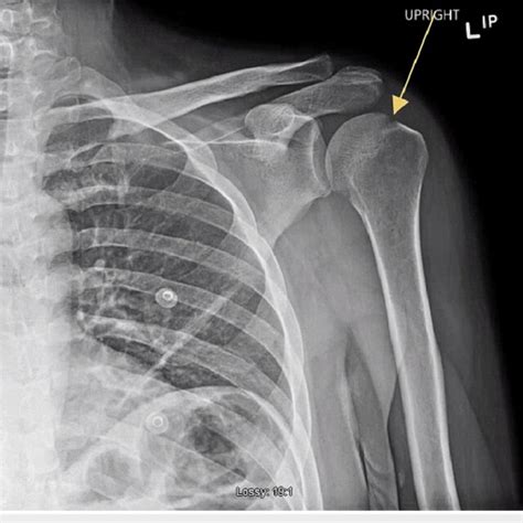 Radiographic Findings Of The Left Shoulder Description Download