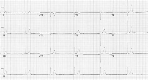 Hypothermia ECG changes • LITFL • ECG Library Diagnosis