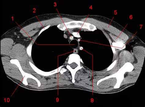 Learn Ct Scan Anatomy Ct Axial Chest Images