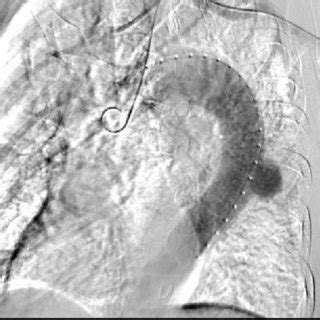 Aortic arch angiography (Before surgery). | Download Scientific Diagram