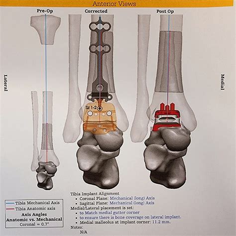 Ankle Replacement Surgery — Associate Professor Roderick Kuo