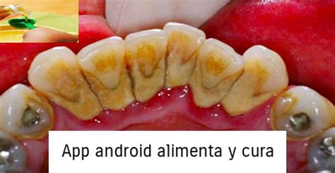 Como Eliminar El Sarro O La Placa Dental En Tan Solo Minutos Y Sin Ir