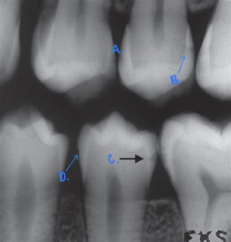 Caries Diagnosis Flashcards | Quizlet