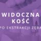 Kiedy zakłada się szwy po wyrwaniu zęba Ekstrakcja z szyciem DentInfo