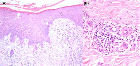 Histopathology showed acanthosis of the epidermis with spongiosis and ...