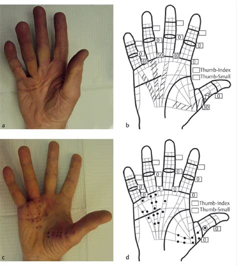 79 Needle Aponeurotomy for Dupuytren’s Disease | Plastic Surgery Key