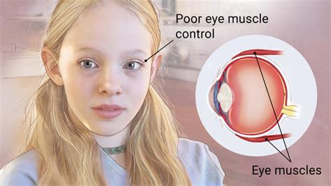 Strabismus | Epping Surgery Centre