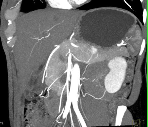 Incidental Neuroendocrine Tumor In The Body Tail Of The Pancreas