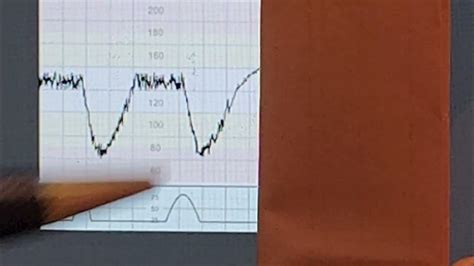 CTG interpretation ( Cardiotocography ) Dr Abdulrahim Gari - YouTube