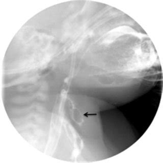 Esophagram Of A Neonate With Esophageal Perforation Anteroposterior