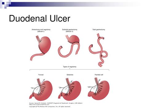 Peptic And Duodenal Ulcer