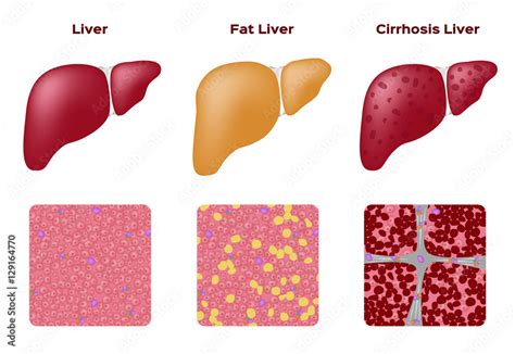 Normal liver Fatty liver and Cirrhosis liver vector Stock Vector | Adobe Stock