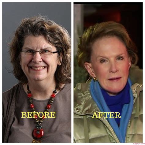 Martha Stewart Plastic Surgery Photos [Before & After] - Surgery4