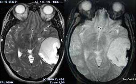 Figure 1 From Temporal Dermoid Cyst With Unusual Imaging Appearance