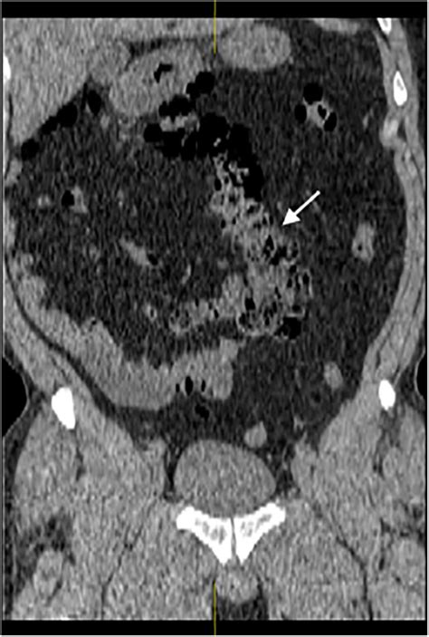 Partial Malrotation Of The Bowel In An Adult Patient Presenting With Abdominal Pain Bmj Case