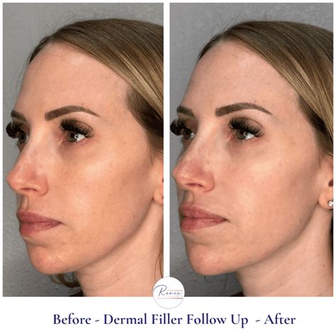 Dermal Fillers Renew Medical Aesthetics