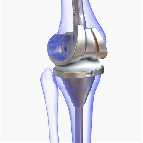 Knee Replacement Implant - 3D Model by zames1992d