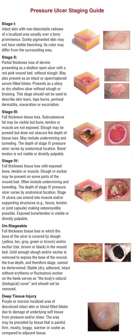 Pressure Ulcer Stages Chart Sexiz Pix The Best Porn Website