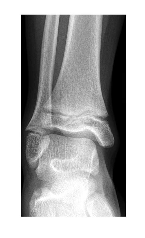 Ankle x-ray 1 | Emergucate