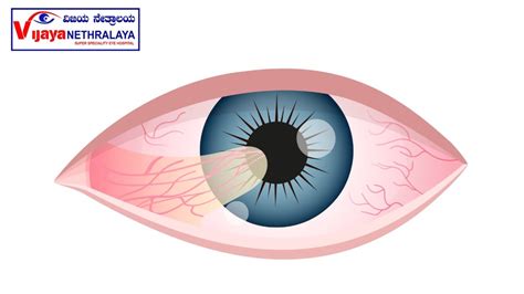 Pterygium: Causes, Symptoms, and Treatment Options