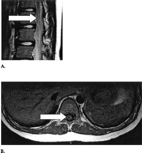 Spinal Magnetic Resonance Image Mri On The Fifth Postoperative Day