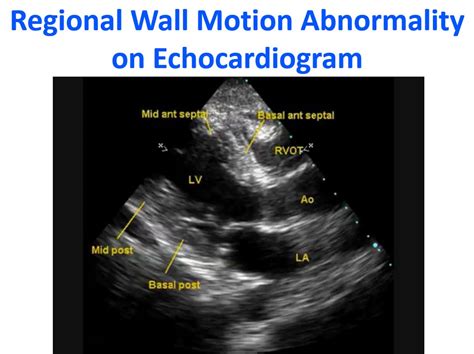 Regional Wall Motion Abnormality On Echocardiogram All About Heart