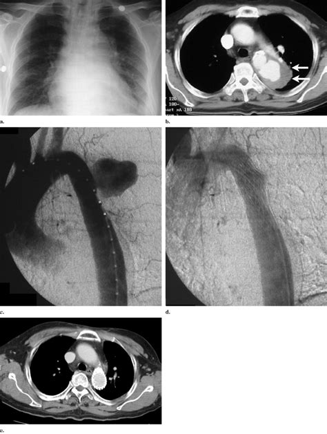 Endovascular Repair Of A Thoracic Aorta Mycotic Pseudoaneurysm In A