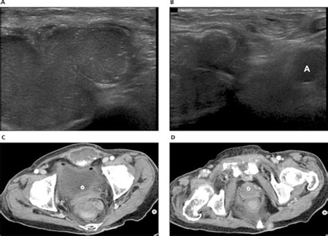 Sonography Of Various Cystic Masses Of The Female Groin Oh 2007 Journal Of Ultrasound In