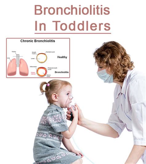 Bronchiolitis In Toddlers Causes Symptoms And Treatments