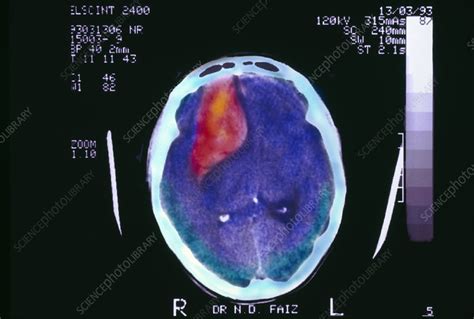 Brain Haemorrhage Ct Scan Stock Image M1360154 Science Photo