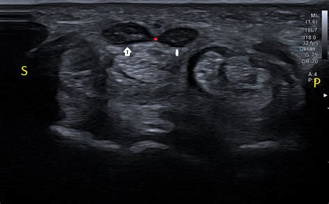 Bifid Median Nerve With Persistent Median Artery In Carpal Tunnel