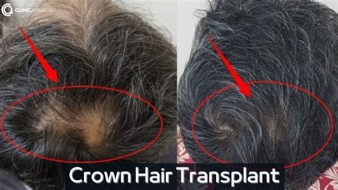 Your Ultimate Guide To Crown Hair Transplant Clinicadvisor®