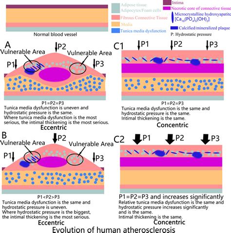 Vulnerable Area Of Atherosclerotic Plaque Rupture Download Scientific Diagram