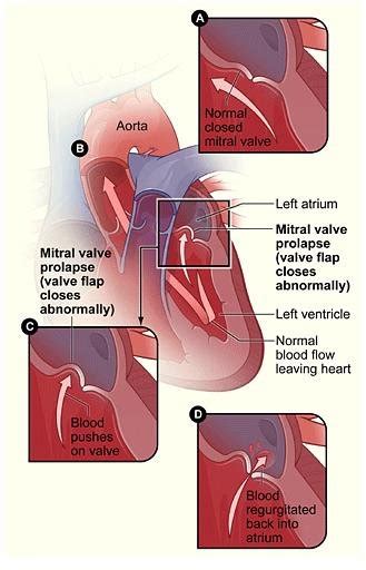 Mitral Valve Prolapse Diagnosis