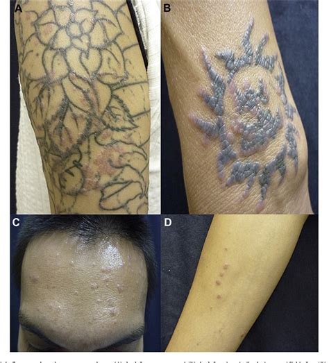 Figure 1 From Generalized Lichenoid Tattoo Reaction With Spontaneous