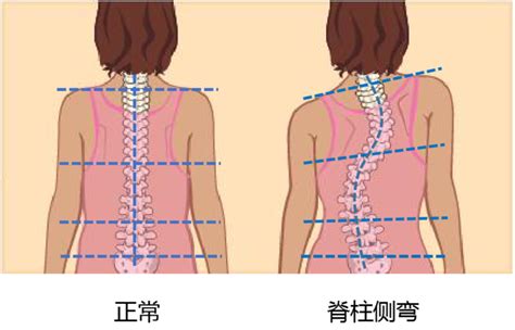 如何知道孩子有没有脊柱侧弯 微医（挂号网）