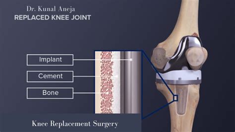 Knee Replacement Surgeon in Delhi - Dr. Kunal Aneja