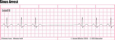 ECG Educator Blog : Six Second ECG Rhythm Strips