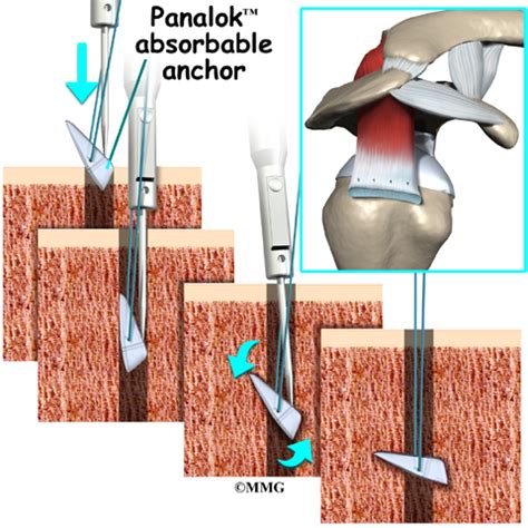 RunAwayImagination: Rotator cuff surgery