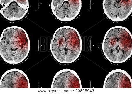 Ischemic Stroke Image & Photo (Free Trial) | Bigstock