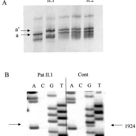 Patient 2 Pcr Sscp Analysis Leading To The Identification Of A