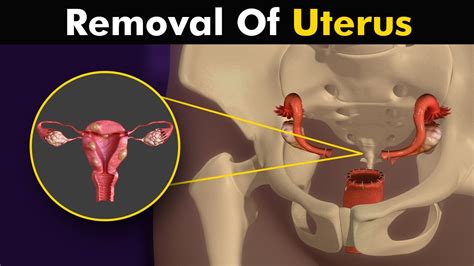 What Happens In Hysterectomy Uterus Removal Surgery Animation Youtube