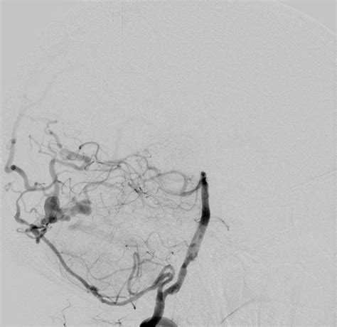 Fistola arterovenosa durale Cosa è e sintomi Dott Paolo Ferroli