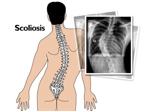 The Best Non Surgical Treatment For Scoliosis In Malaysia