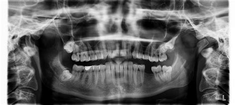 Tomografia Komputerowa Z B W Na Czym Polega Dental Diamond